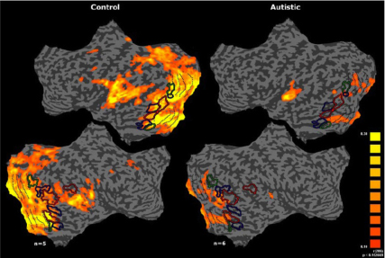autistic brain (right) shows massive disruption in responses to the external world
