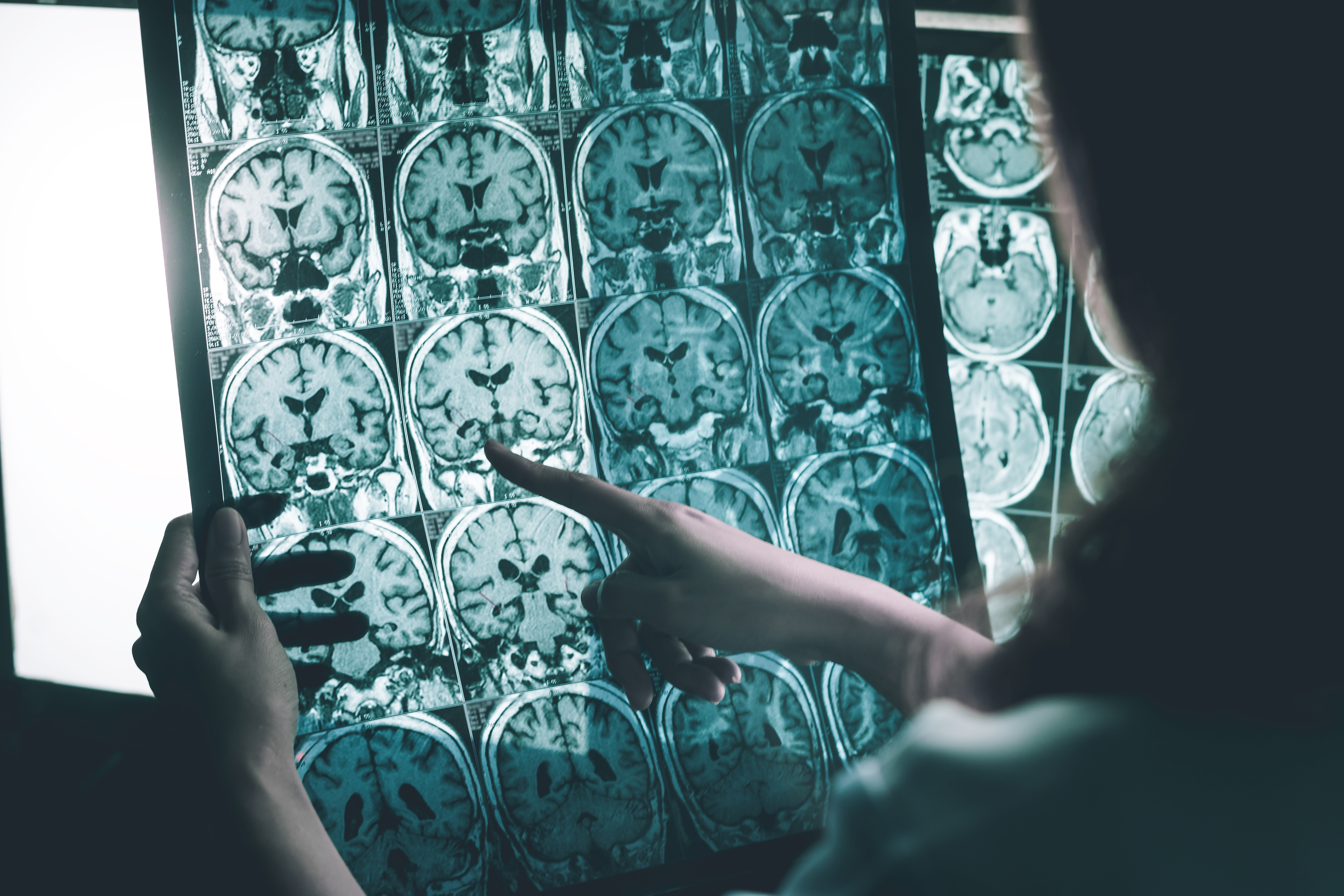 Is “Friendly Fire” in the Brain Provoking Alzheimer’s Disease?