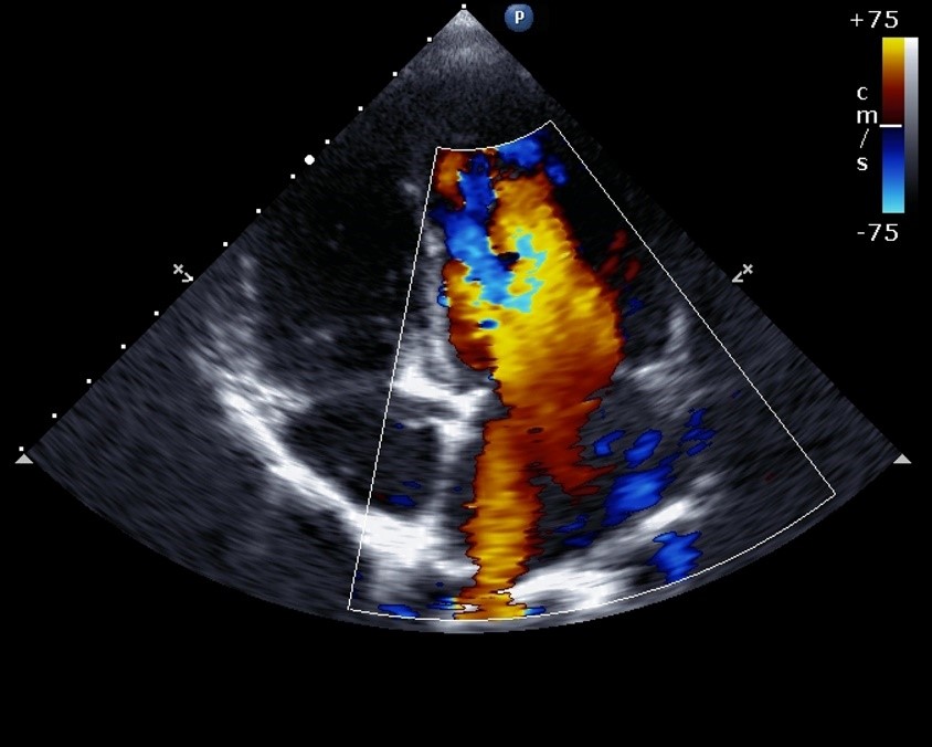 An Algorithm That Rivals Experts’ Ultrasound Skills Could Save Lives