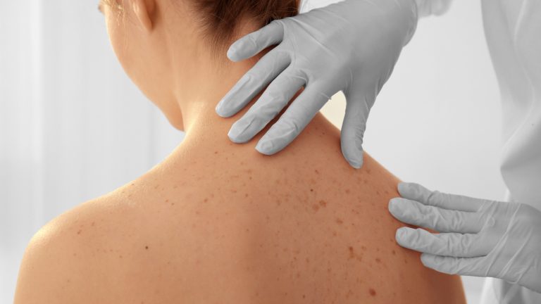Ultra-Personalized Therapy for Melanoma