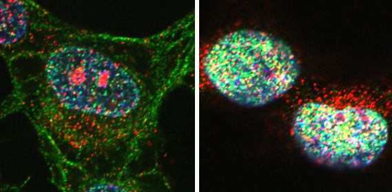 Novel Molecular Marker May Improve Prostate Cancer Treatment 2