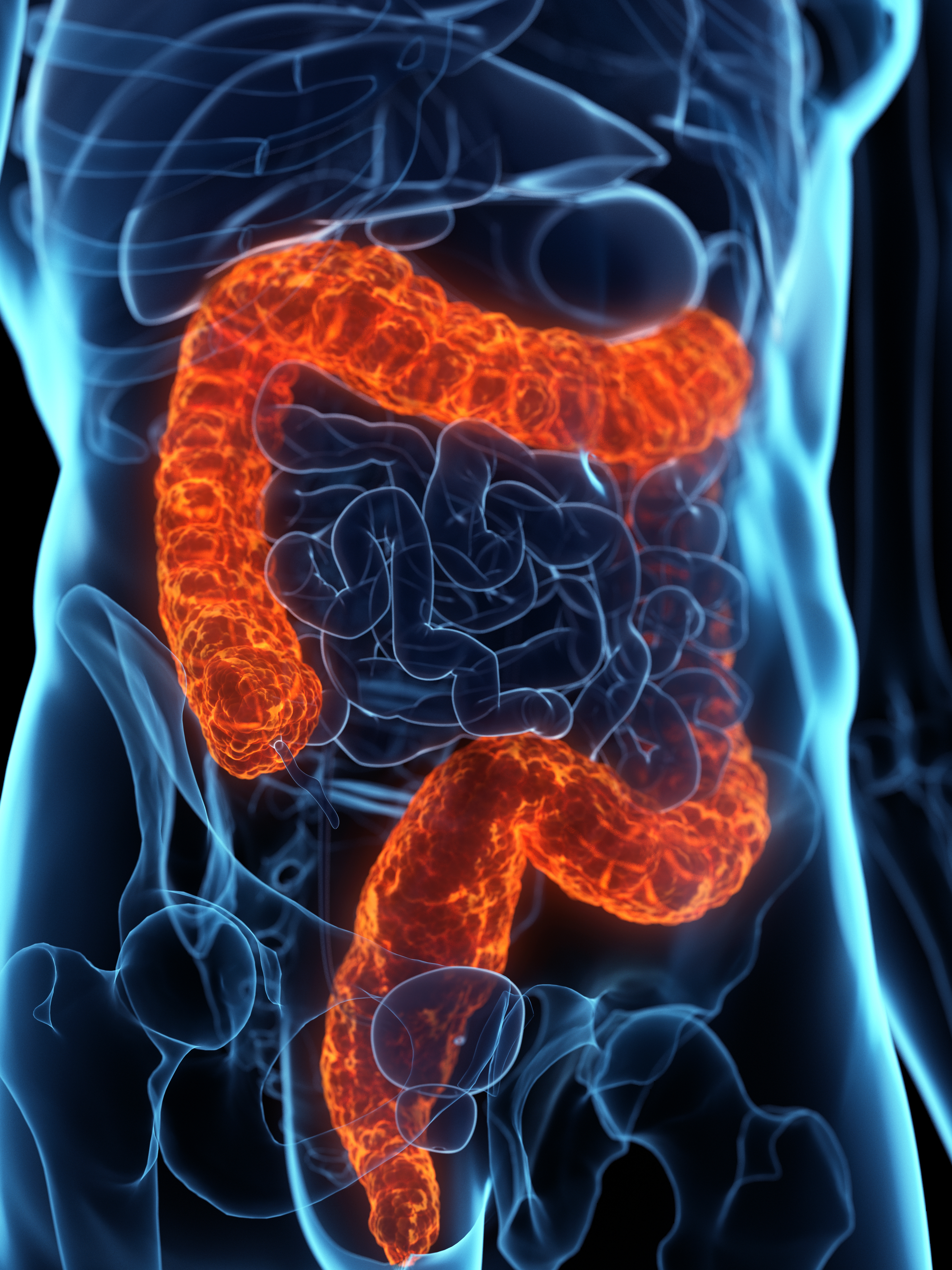A Noninvasive Test for Gut Inflammation