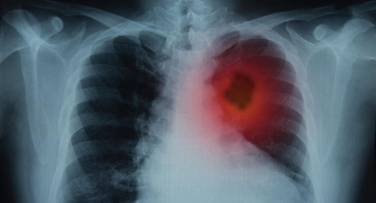 Israeli Study Finds Biological Treatment Effective For Lung Cancer
